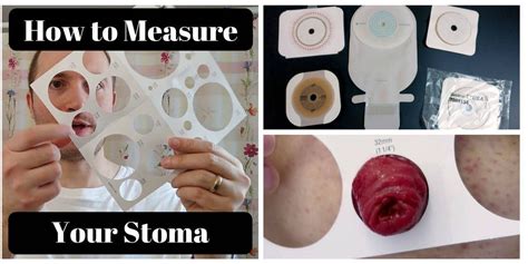 How to Measure Your Stoma: Ostomy Tips | VeganOstomy | Stoma, Ostomy, How to measure yourself