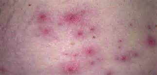 Pseudomonas folliculitis | Clinical Gate