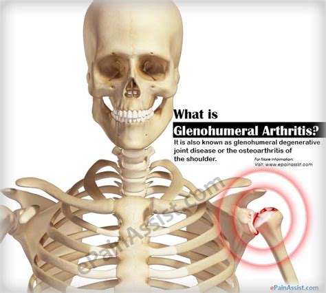 Glenohumeral Arthritis|Causes|Symptoms|Treatment|Prognosis|Pathophysiology|Epidemiology