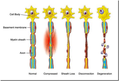 Damaged Small Nerves Lead To Damaged Longer Nerves | Neuropathy and HIV