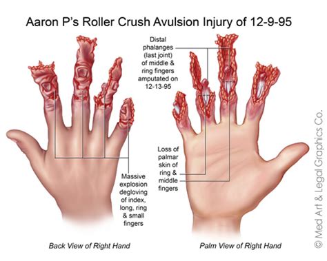 Crush Avulsion Injury and Toe Transfer Surgery