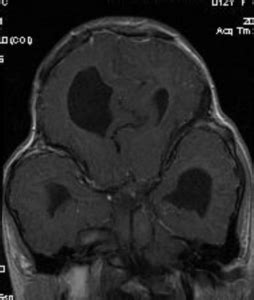 Cloverleaf skull syndrome - NeuroRad911