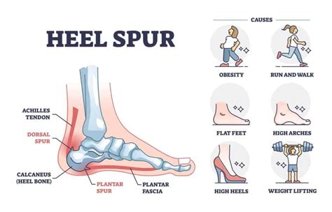 Heel Spur: Causes, Symptoms, Treatment - York Rehab Clinic