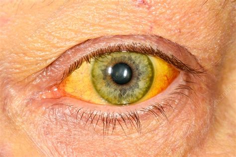 Jaundiced eye - Stock Image - C038/1689 - Science Photo Library