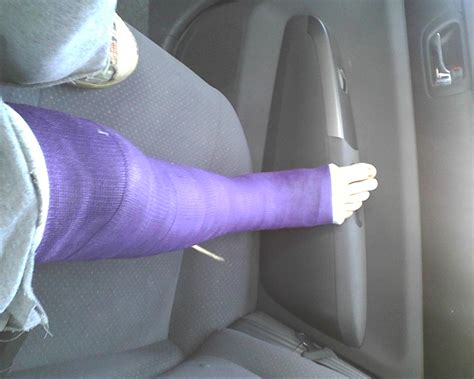 Hard To Handle.: Update on the Leg