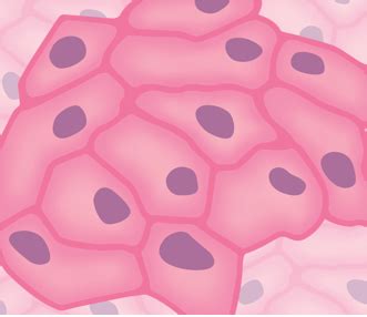 Epithelioid Mesothelioma | Mesothelioma Guide