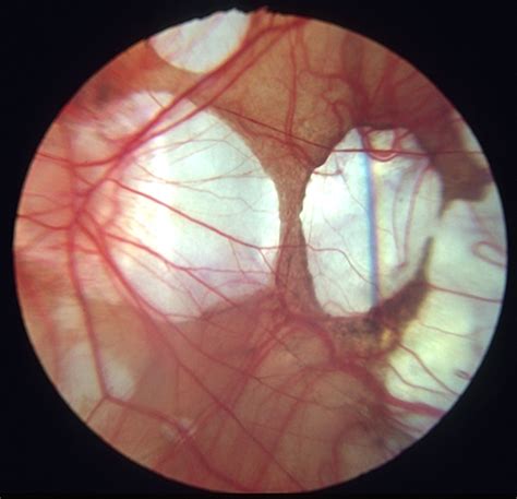 Myopic macular degeneration - Retina Image Bank