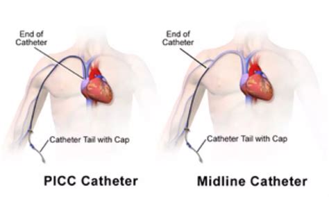 Central catheters safer than PICCs for short-term venous access: JAMA