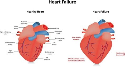 Does Heart Failure Affect Blood Pressure - Printable Templates Protal