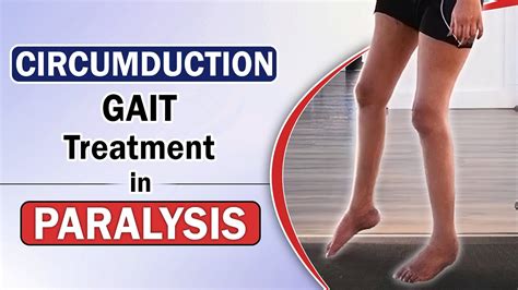 Circumduction Gait Treatment in Paralysis | Paralysis Patient Leg Movement Exercises | SRIAAS ...