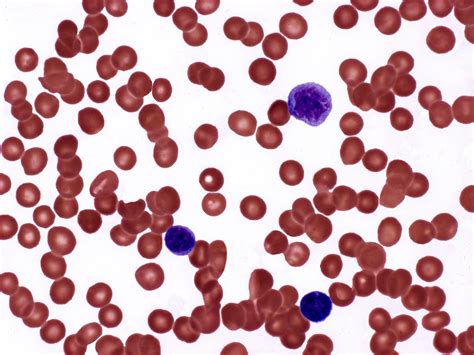 Patients With Polycythemia Vera Mostly Remain in Target Hematocrit ...