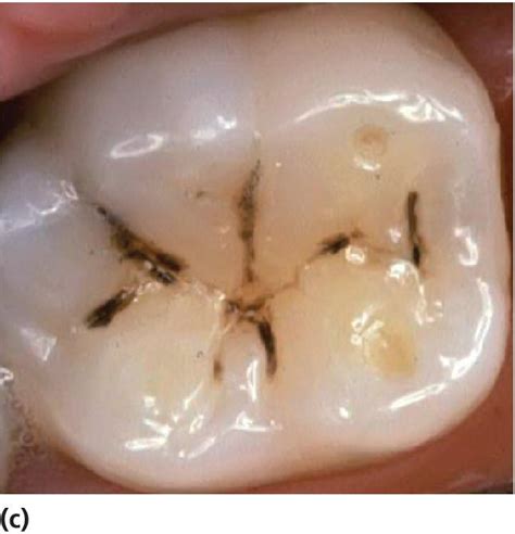 Top 95+ Images Shallow Pit Or Cavity In Or On A Bone Updated 11/2023