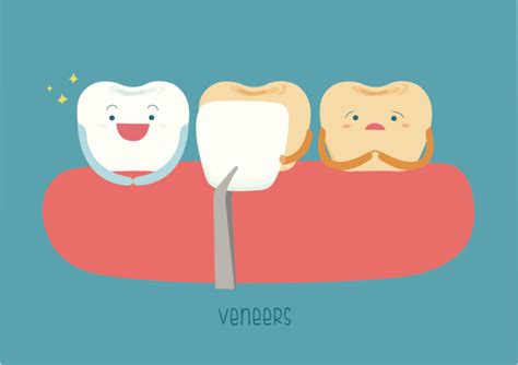 What are Dental Veneers?