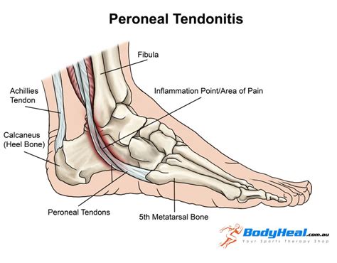 Peroneal tendinopathy, PhysioNow, Mississauga, Physiotherapy