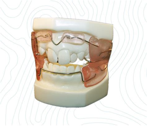 Frankel Orthodontic Appliance | Types of Frankel Functional Appliance