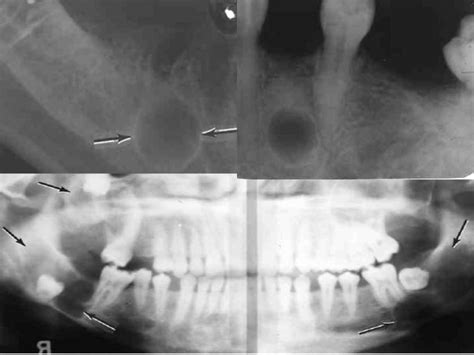 Odontogenic Cysts