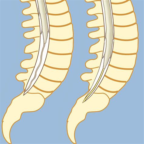 Tethered Spinal Cord | Brain & Spine Center