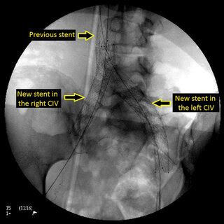 Stents deployed in the right and left common iliac veins. CIV: common... | Download Scientific ...