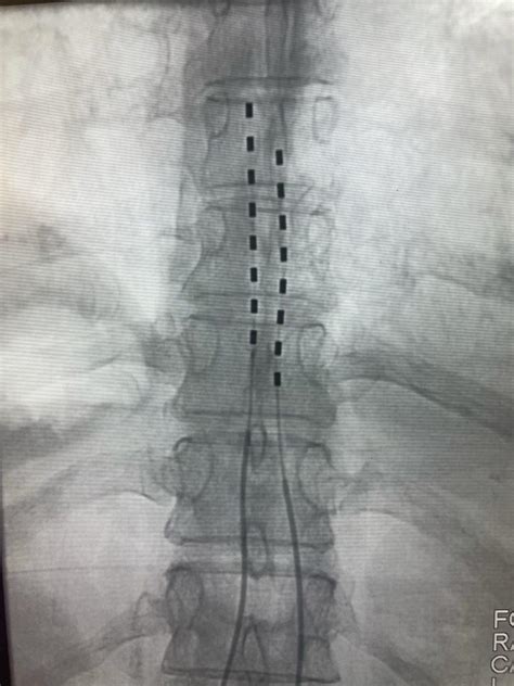 Spinal Cord Stimulator | Interventional Radiology located in Denver and ...