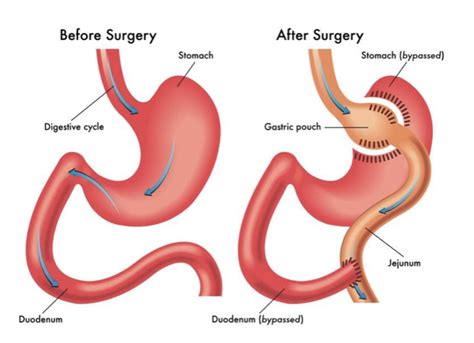 Roux-en-Y Gastric Bypass (RYGB) surgery - The Endocrine Doc