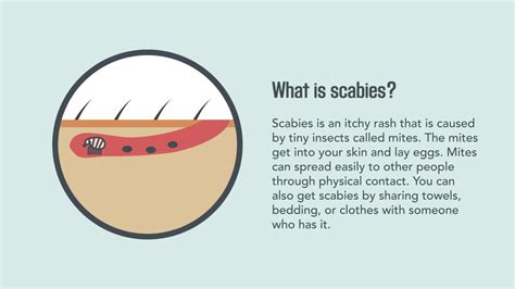 How To Spot Scabies - Headassistance3