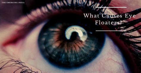 What Causes Eye Floaters? Symptoms, Treatments & Causes
