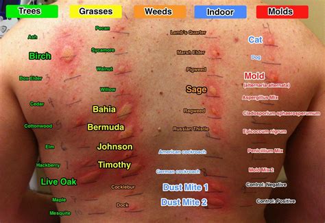 Allergy testing for #mold - | Allergy remedies, Dust allergy, Dust mite allergy