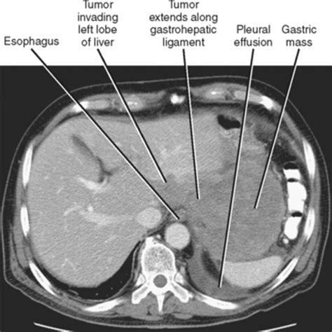 Localization and Spread of Disease | Radiology Key