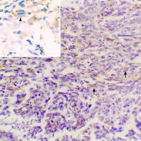 Spindle cell carcinoma demonstrating spindle cells area (white arrow ...