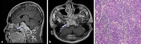 a Sagittal section of MRI of the brain showing destruction of the... | Download Scientific Diagram