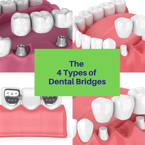 Cantilever Dental Bridge