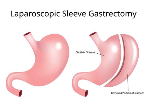 Sleeve Gastrectomy Procedure and All about it | Healing Clinic Turkey