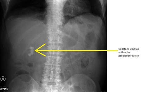 Gallstone disease x ray - wikidoc