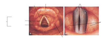 rima glottis Diagram | Quizlet