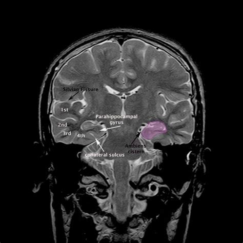 MRI Brain ambiens cistern anatomy | Radiology Anatomy Images | Mri ...