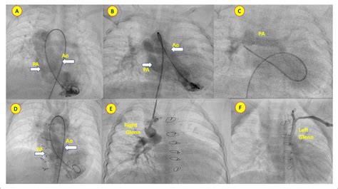 Angiogram at basal state (A,B,C) and post-bilateral bidirectional Glenn ...