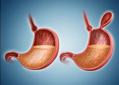 Bowel Obstruction: Symptoms, Causes, Diagnosis, and Treatment