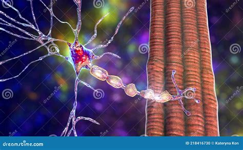 Demyelination of Neuron, the Damage of the Neuron Myelin Sheath Seen in Demyelinating Diseases ...