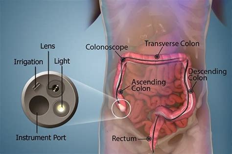 What is a Colonoscopy? | Hill Regional Hospital