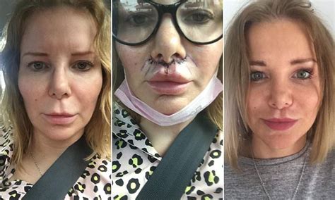 Woman, 45, has lip lift surgery to curb her 'resting b**** face' | Daily Mail Online