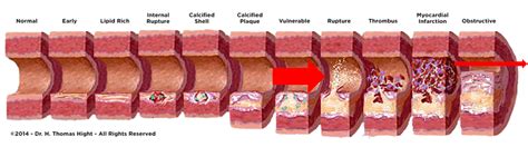 Stress tests are for symptoms. Stress tests can miss vulnerable plaque at risk for heart attack ...