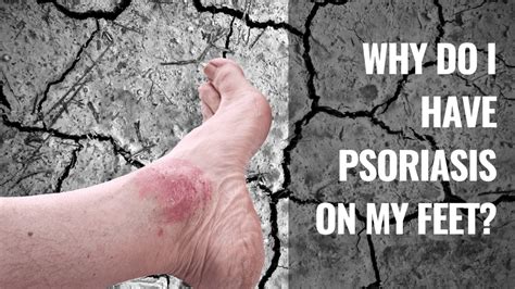 Pustular Psoriasis Foot