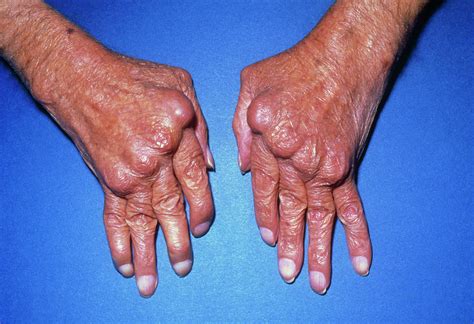 Hands With Rheumatoid Arthritis Photograph by James Stevenson/science Photo Library - Pixels