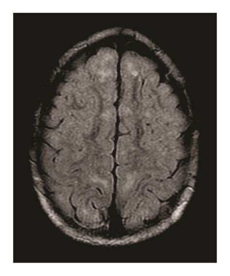 Axial T2-FLAIR MRI image demonstrating subcortical white matter... | Download Scientific Diagram