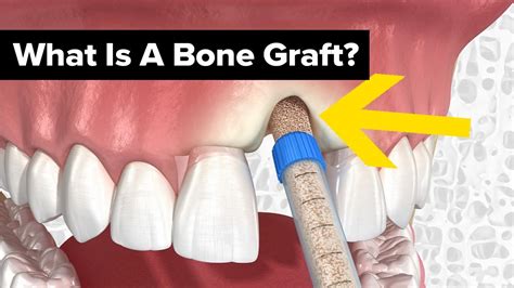 How Much Does Dental Bone Grafting Cost? | Dentist Norcross & Alpharetta, GA