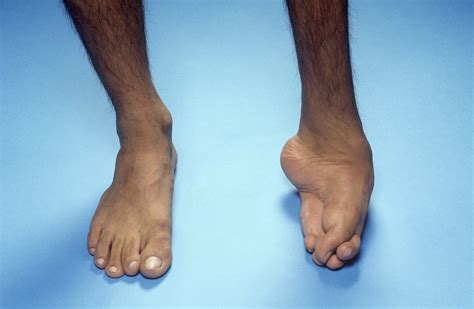 Talipes Equinovarus (Clubfoot) and Other Foot Abnormalities ...