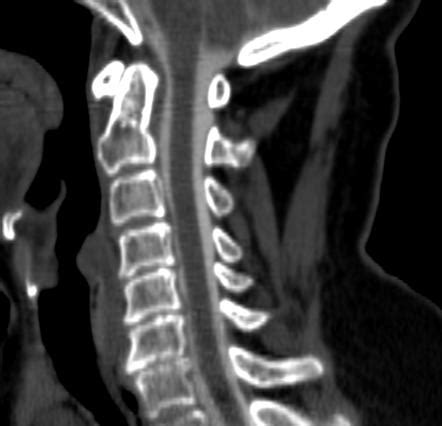 Myelography | Radiology Reference Article | Radiopaedia.org