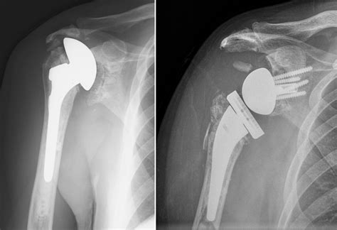 Patient Satisfaction/Complications Following Revision of Failed ...