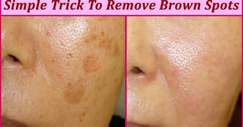 Simple Trick To Remove Brown Spots From Your Skin - TOP 5 DIY