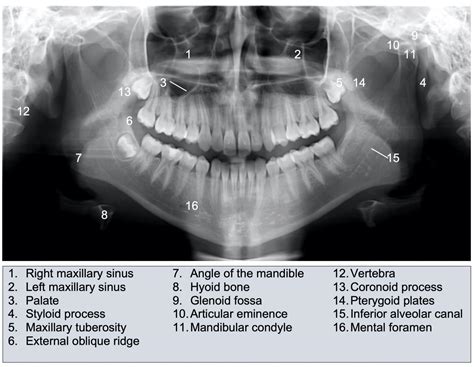 Mandibular Fractures | Anatomy, Management | Geeky Medics